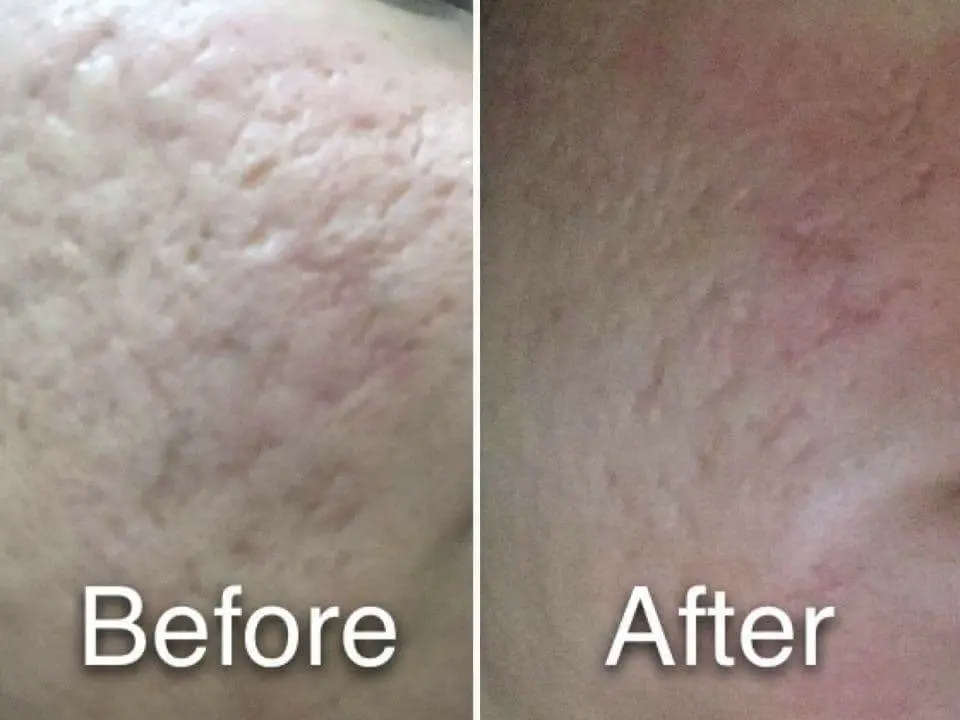 Acne Treatments in McAllen, TX