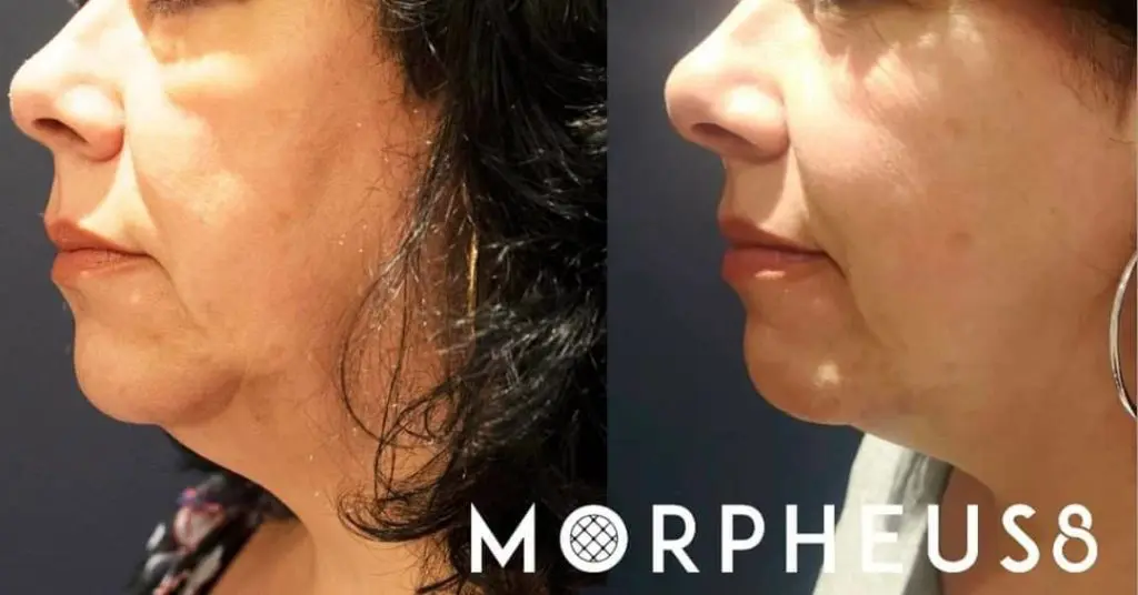 Morpheus8 RF Microneedling McAllen, TX | Morpheus8 RF Microneedling