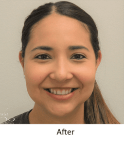 Before and After Pictures McAllen, TX - Ayala ENT and Facial Plastic Surgery