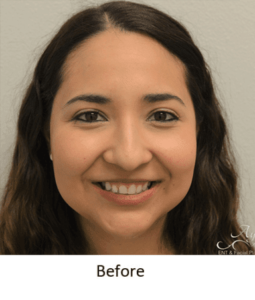 Before and After Pictures McAllen, TX - Ayala ENT and Facial Plastic Surgery