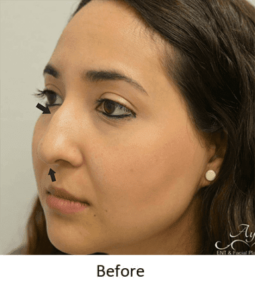 Before and After Pictures McAllen, TX - Ayala ENT and Facial Plastic Surgery