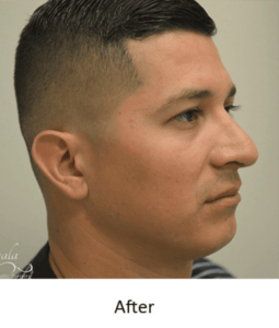 Before and After Pictures McAllen, TX - Ayala ENT and Facial Plastic Surgery