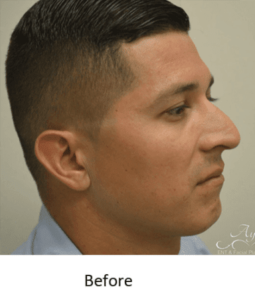 Before and After Pictures McAllen, TX - Ayala ENT and Facial Plastic Surgery