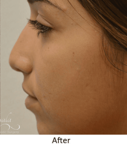 Before and After Pictures McAllen, TX - Ayala ENT and Facial Plastic Surgery