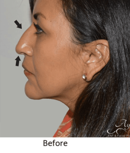 Before and After Pictures McAllen, TX - Ayala ENT and Facial Plastic Surgery