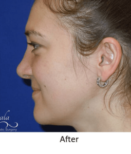 Before and After Pictures McAllen, TX - Ayala ENT and Facial Plastic Surgery