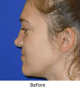 Before and After Pictures McAllen, TX - Ayala ENT and Facial Plastic Surgery