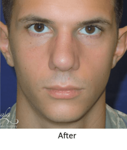 Before and After Pictures McAllen, TX - Ayala ENT and Facial Plastic Surgery