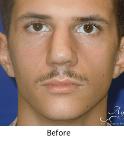 Before and After Pictures McAllen, TX - Ayala ENT and Facial Plastic Surgery