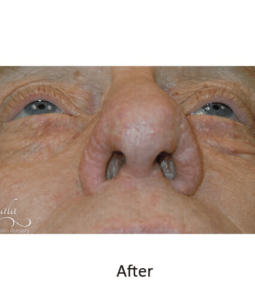 Before and After Pictures McAllen, TX - Ayala ENT and Facial Plastic Surgery