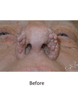 Before and After Pictures McAllen, TX - Ayala ENT and Facial Plastic Surgery