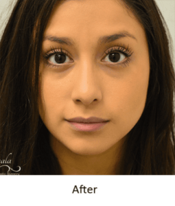 Before and After Pictures McAllen, TX - Ayala ENT and Facial Plastic Surgery