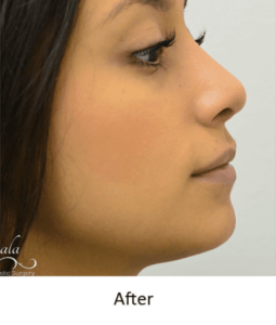 Before and After Pictures McAllen, TX - Ayala ENT and Facial Plastic Surgery