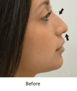 Before and After Pictures McAllen, TX - Ayala ENT and Facial Plastic Surgery