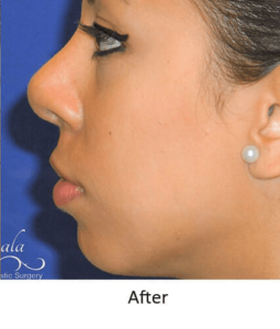 Before and After Pictures McAllen, TX - Ayala ENT and Facial Plastic Surgery