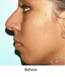 Before and After Pictures McAllen, TX - Ayala ENT and Facial Plastic Surgery