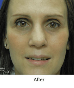 Before and After Pictures McAllen, TX - Ayala ENT and Facial Plastic Surgery