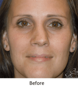 Before and After Pictures McAllen, TX - Ayala ENT and Facial Plastic Surgery