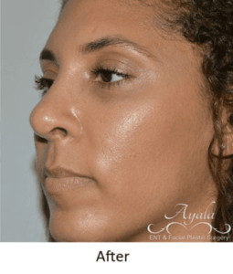 Before and After Pictures McAllen, TX - Ayala ENT and Facial Plastic Surgery