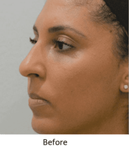 Before and After Pictures McAllen, TX - Ayala ENT and Facial Plastic Surgery