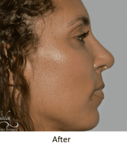 Before and After Pictures McAllen, TX - Ayala ENT and Facial Plastic Surgery