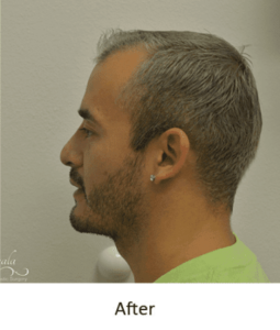 Rhinoplasty Before and After Pictures McAllen, TX