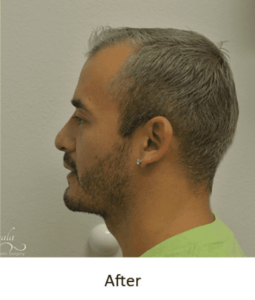 Before and After Pictures McAllen, TX - Ayala ENT and Facial Plastic Surgery