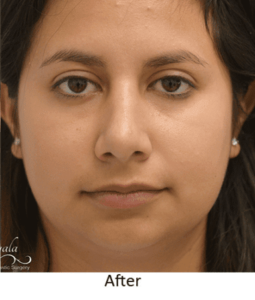 Before and After Pictures McAllen, TX - Ayala ENT and Facial Plastic Surgery