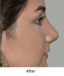 Before and After Pictures McAllen, TX - Ayala ENT and Facial Plastic Surgery