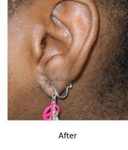 Before and After Pictures McAllen, TX - Ayala ENT and Facial Plastic Surgery