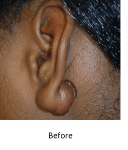 Ear Surgery Before and After Pictures McAllen, TX