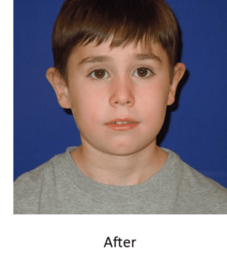 Before and After Pictures McAllen, TX - Ayala ENT and Facial Plastic Surgery