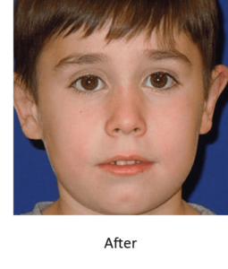 Before and After Pictures McAllen, TX - Ayala ENT and Facial Plastic Surgery