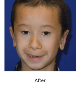 Before and After Pictures McAllen, TX - Ayala ENT and Facial Plastic Surgery