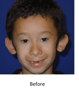 Ear Surgery Before and After Pictures McAllen, TX