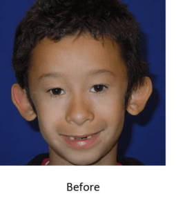 Before and After Pictures McAllen, TX - Ayala ENT and Facial Plastic Surgery