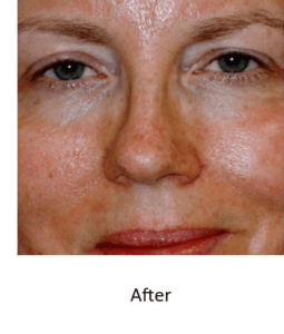 Before and After Pictures McAllen, TX - Ayala ENT and Facial Plastic Surgery