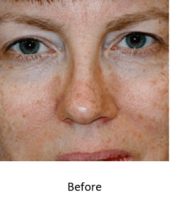 Before and After Pictures McAllen, TX - Ayala ENT and Facial Plastic Surgery