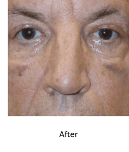 Before and After Pictures McAllen, TX - Ayala ENT and Facial Plastic Surgery