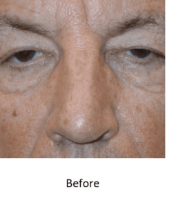 Before and After Pictures McAllen, TX - Ayala ENT and Facial Plastic Surgery