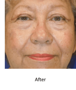 Before and After Pictures McAllen, TX - Ayala ENT and Facial Plastic Surgery