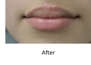 Lip Augmentation Before and After Pictures McAllen, TX