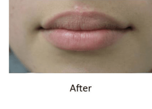 Before and After Pictures McAllen, TX - Ayala ENT and Facial Plastic Surgery