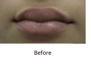 Lip Augmentation Before and After Pictures McAllen, TX