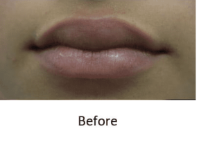 Before and After Pictures McAllen, TX - Ayala ENT and Facial Plastic Surgery