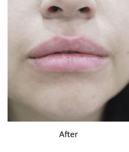 Before and After Pictures McAllen, TX - Ayala ENT and Facial Plastic Surgery