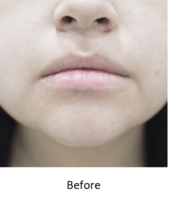 Before and After Pictures McAllen, TX - Ayala ENT and Facial Plastic Surgery