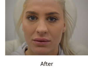 Before and After Pictures McAllen, TX - Ayala ENT and Facial Plastic Surgery