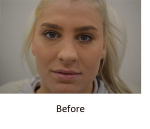 Before and After Pictures McAllen, TX - Ayala ENT and Facial Plastic Surgery