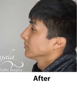 Before and After Pictures McAllen, TX - Ayala ENT and Facial Plastic Surgery